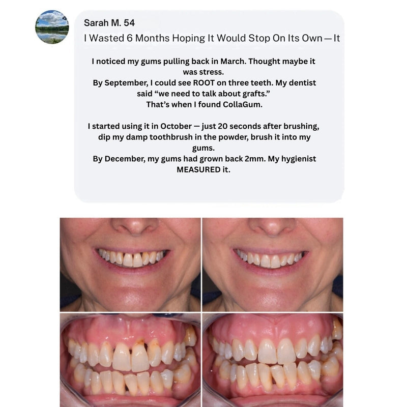 CollaGum™: Stop Your Gums From Receding Without Surgery—Rebuild Your Gumline's Natural Defense