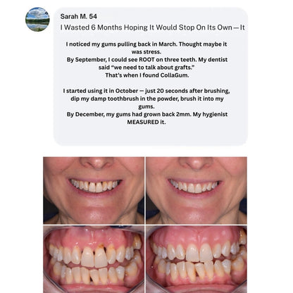 CollaGum™: Stop Your Gums From Receding Without Surgery—Rebuild Your Gumline's Natural Defense